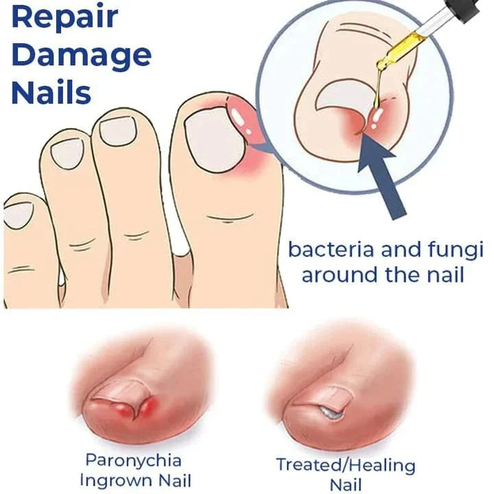 Anti Paronychia Relief Oil - (Buy 1 Get 1 FREE🔥🔥)