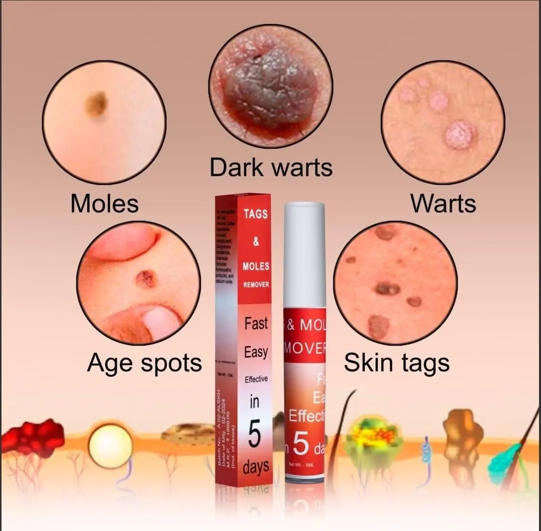 Warts & Tags Remover Pen - (Buy 1 Get 1 FREE🔥🔥)